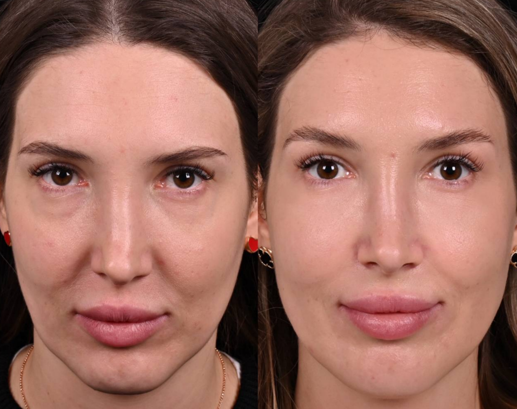 Липофилинг лица и век фото до и после. Фото с сайта хирурга Д.Р. Гришкяна. Имеются противопоказания, требуется консультация специалиста