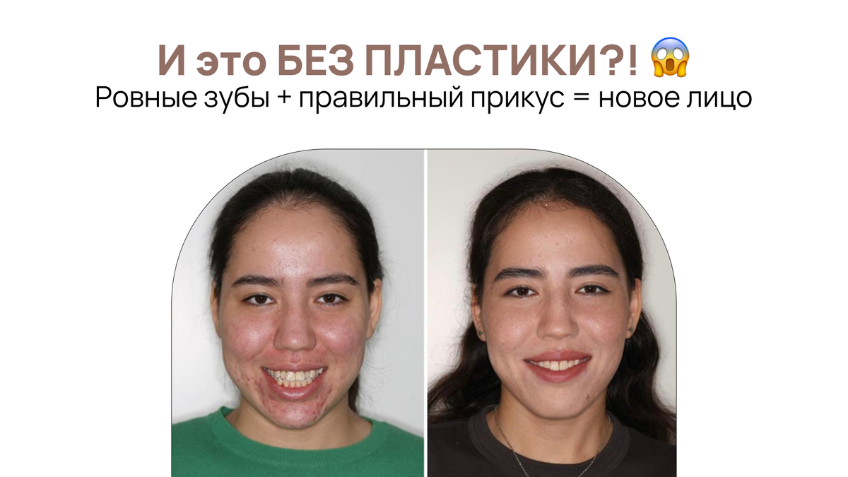 Брекеты, которые изменили не только зубы, но и лицо: как грамотное лечение улучшает внешний вид и здоровье