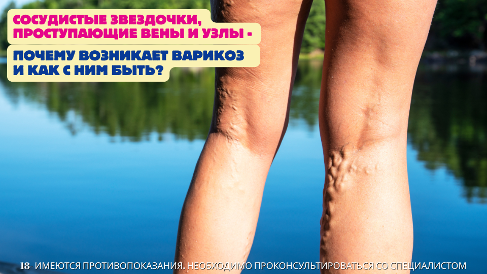 Сосудистые звездочки, проступающие вены и узлы - почему возникает варикоз и как с ним быть