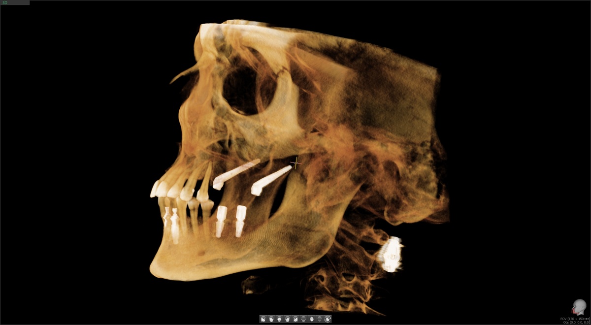 Птеригоидные имплантаты сверху, классические снизу