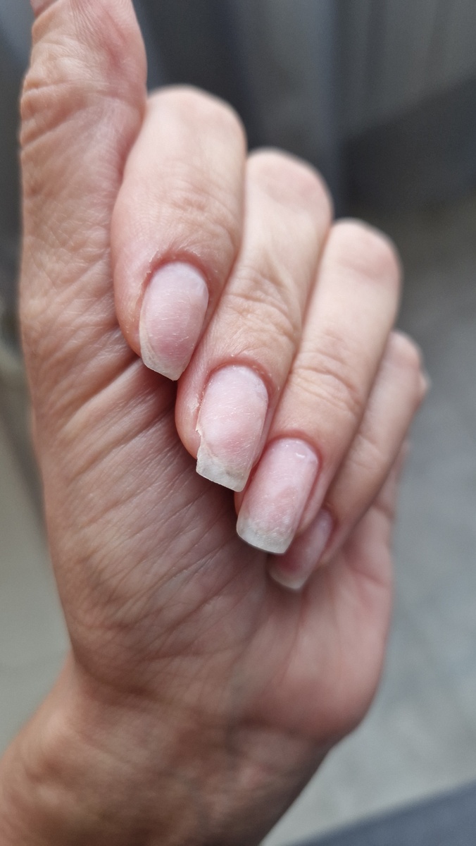 Состояние ногтей после снятия покрытия.