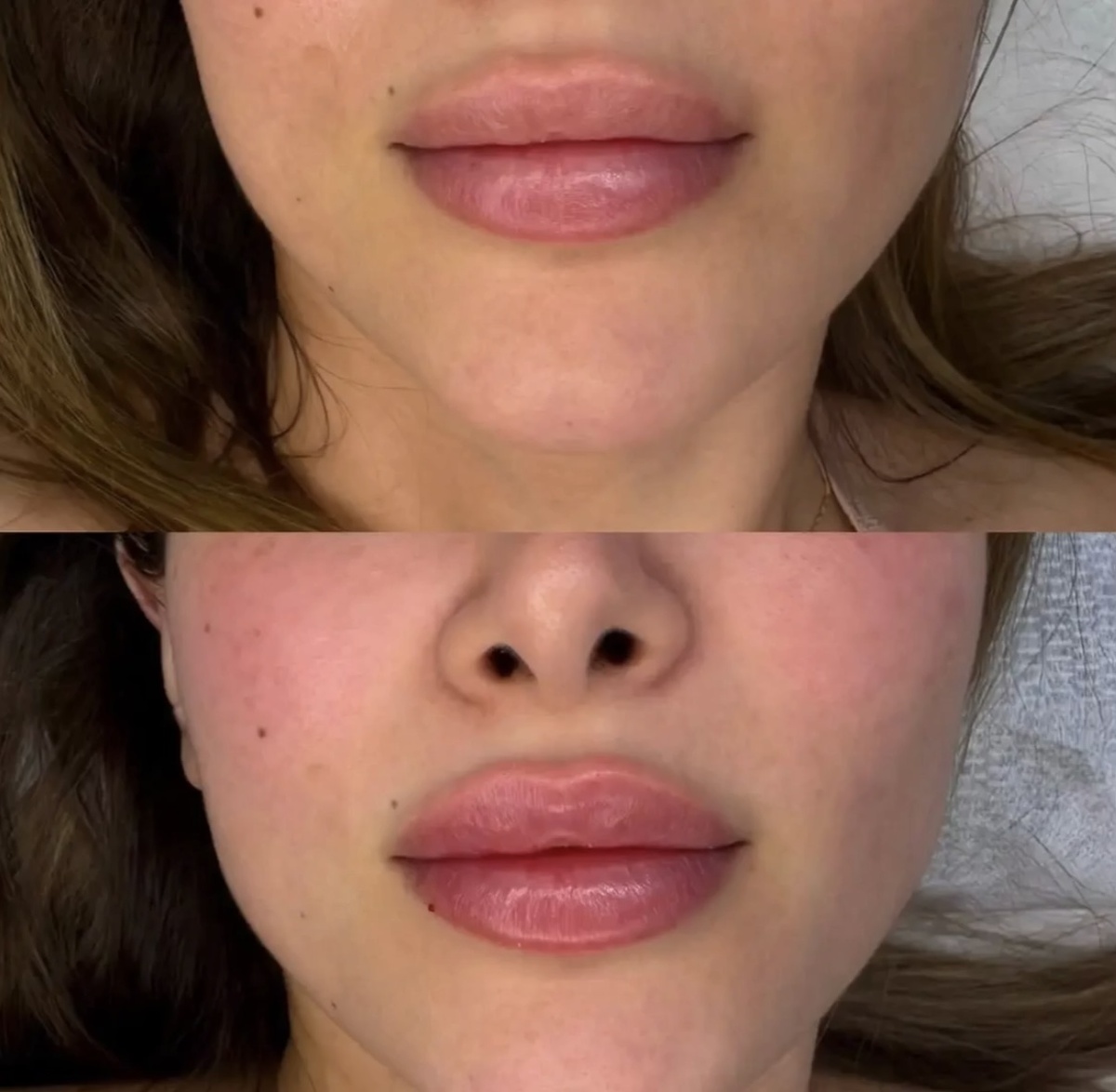 До — неравномерное распределение филлера. После коррекции — восстановлена анатомическая симметрия. Автор вмешательства: я :)