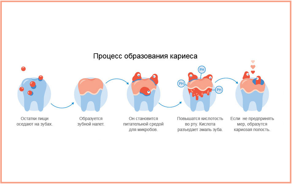 Как образуется кариес