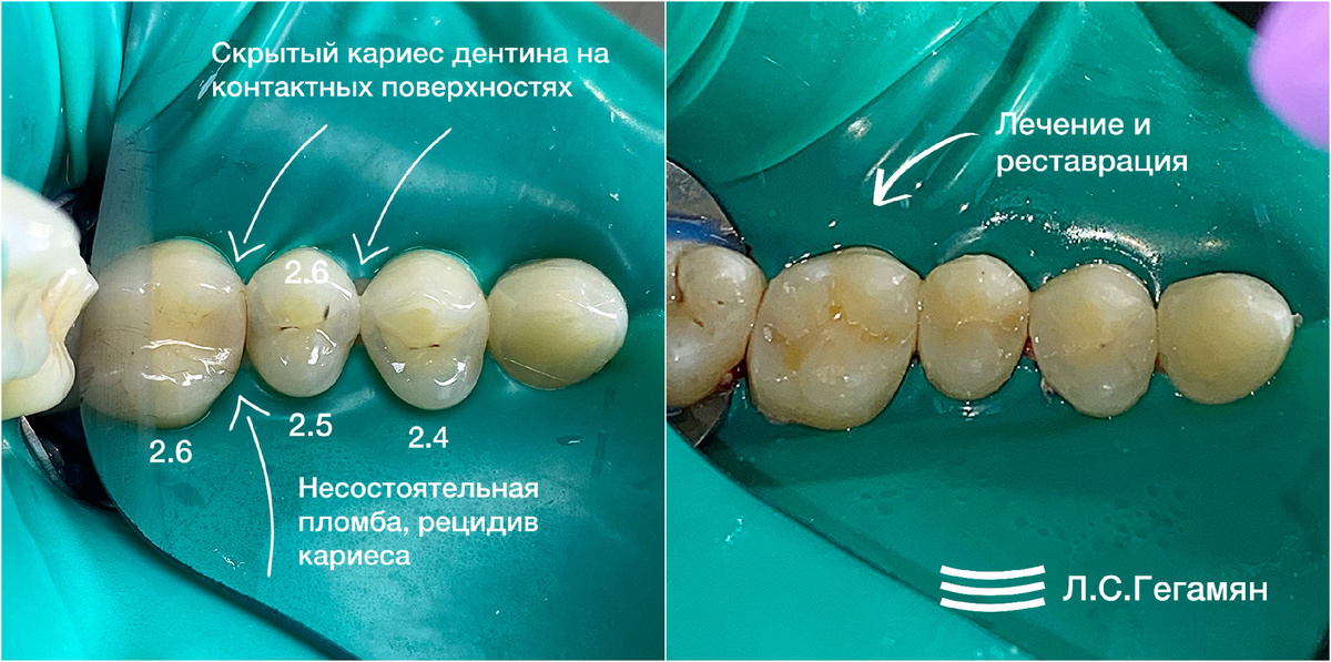 Лечение кариеса на жевательных и контактных поверхностях сразу 3-х зубов: 2.6, 2.5, 2.4 у молодого человека 30-ти лет