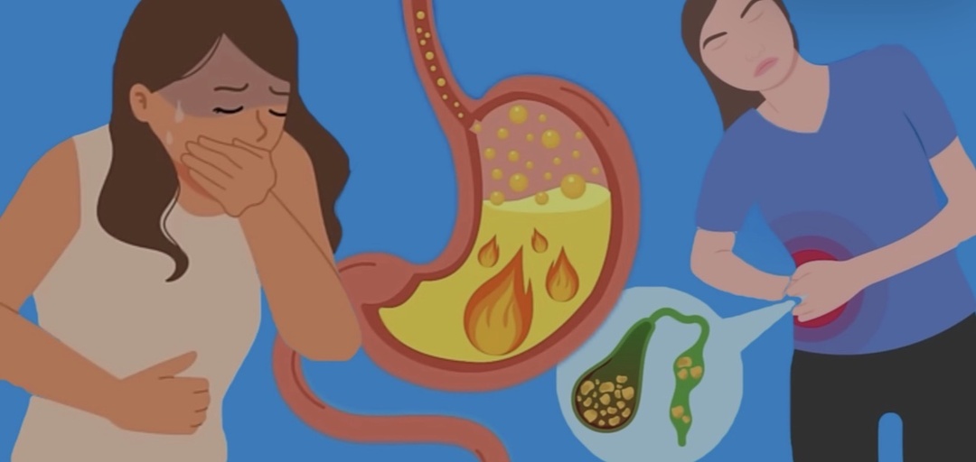 Растворение камней в желчном пузыре: что действительно возможно?