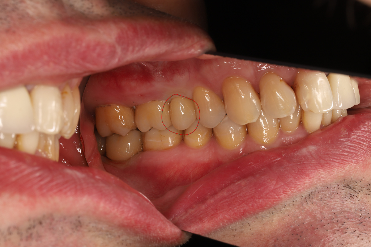 Кейс Виталия Ильгамовича по установке коронки на дентальный имплантат.