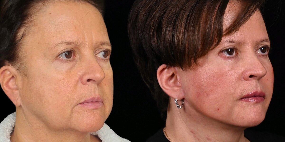 SMAS-подтяжка лица и блефаропластика верхних век. Фото до и после. Фото с сайта хирурга Д.Р. Гришкяна. Имеются противопоказания, требуется консультация специалиста