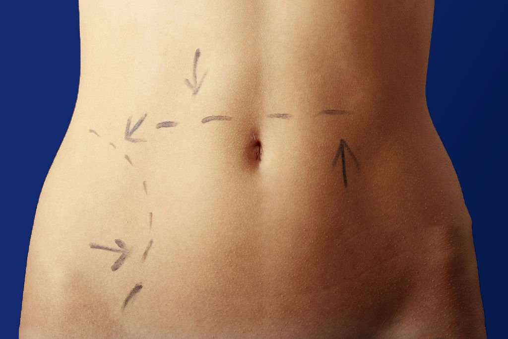 Подготовка к операции липосакции 