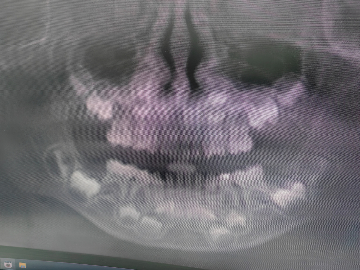 Так выглядит панорамный снимок челюсти Маргариты.