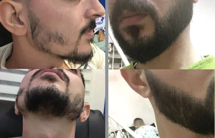 Одна из работ до и после пересадки бороды (доктор Кексал Дениз)