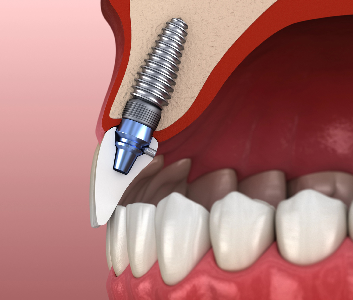 Имплантация зубов под ключ с коронкой, имплантом и абатментом
