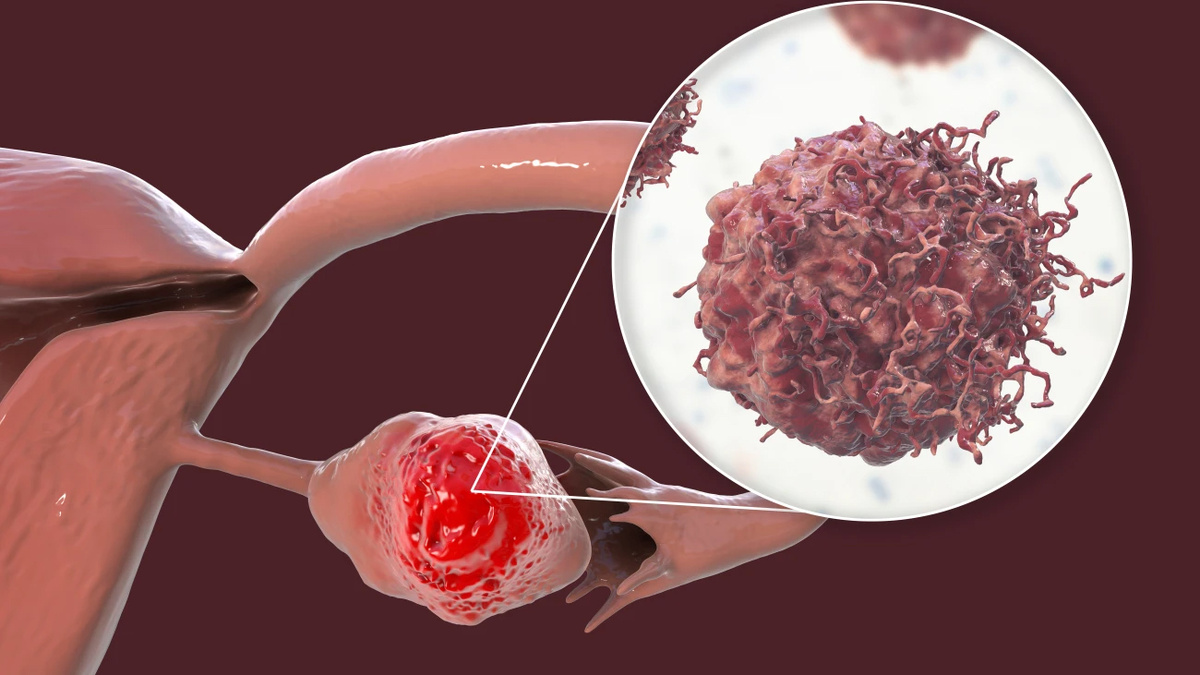 Опухоль яичника