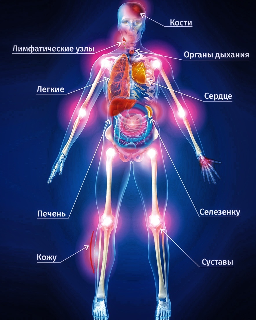Что поражает саркоидоз? Основные органы - мишени 