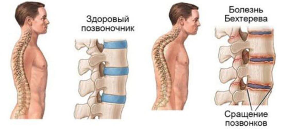 Рис 1. Патологические изменения в позвоночнике при болезни Бехтерева