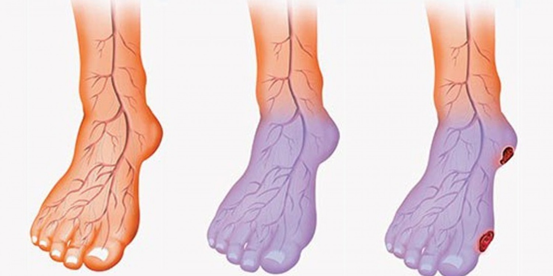 Холодные стопы: слабое кровообращение или норма?