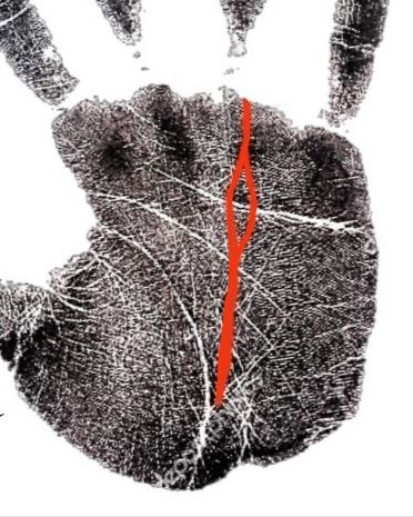 Остров на линии Аполлона (здоровье)