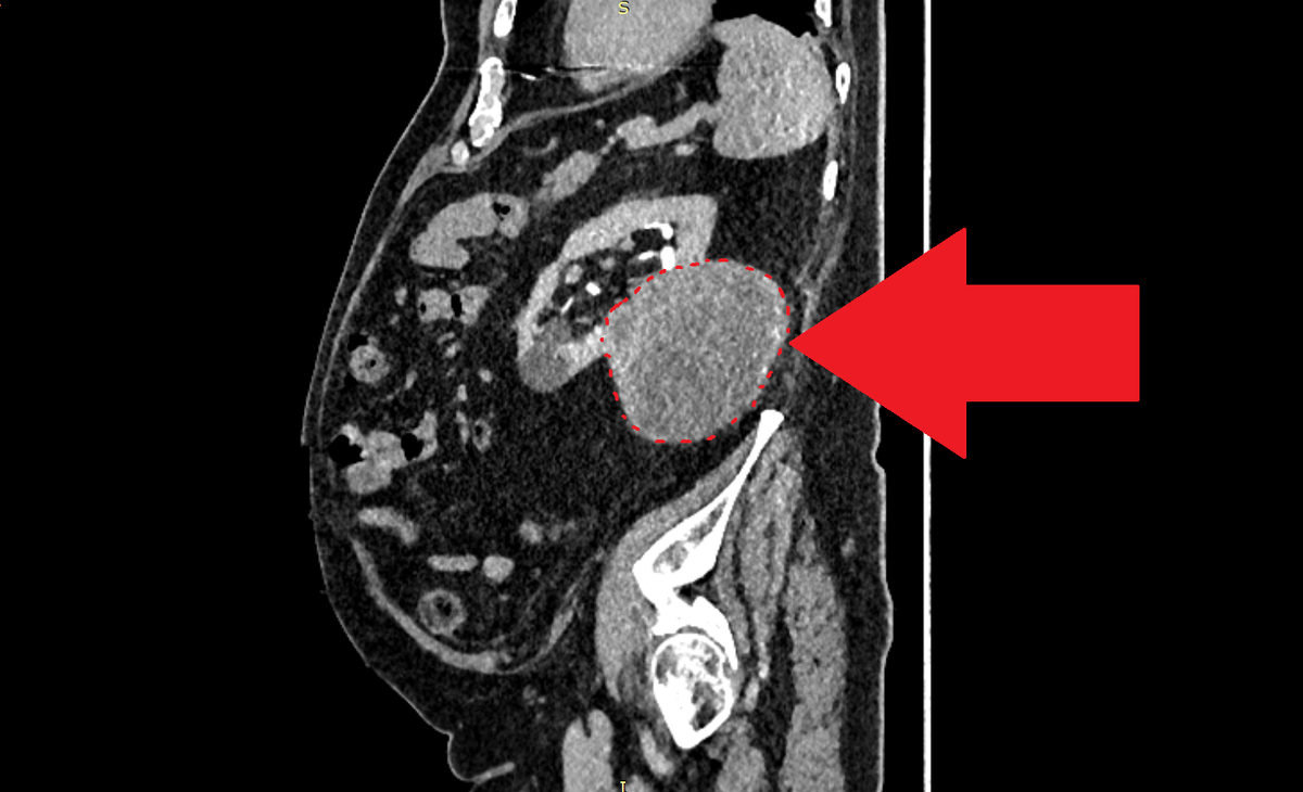 КТ с контрастированием. Стрелка указывает на опухоль, исходящую из заднего полюса левой почки. Новообразование таких размеров не вызывает боли у пациента.