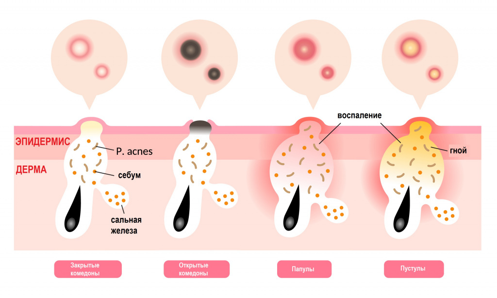 Источник изображения:  https://www.invitro.ru/library/bolezni/28295/
