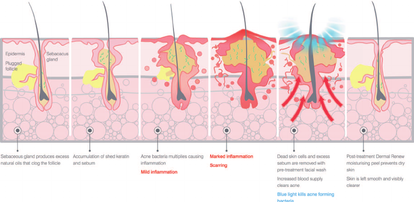 Источник: Ash, C., Harrison, A., Drew, S., Whittall, R., 2015. A randomized controlled study for the treatment of acne vulgaris using high-intensity 414 nm solid state diode arrays. Journal of Cosmetic and Laser Therapy 17, 170–176. https://doi.org/10.3109/14764172.2015.1007064