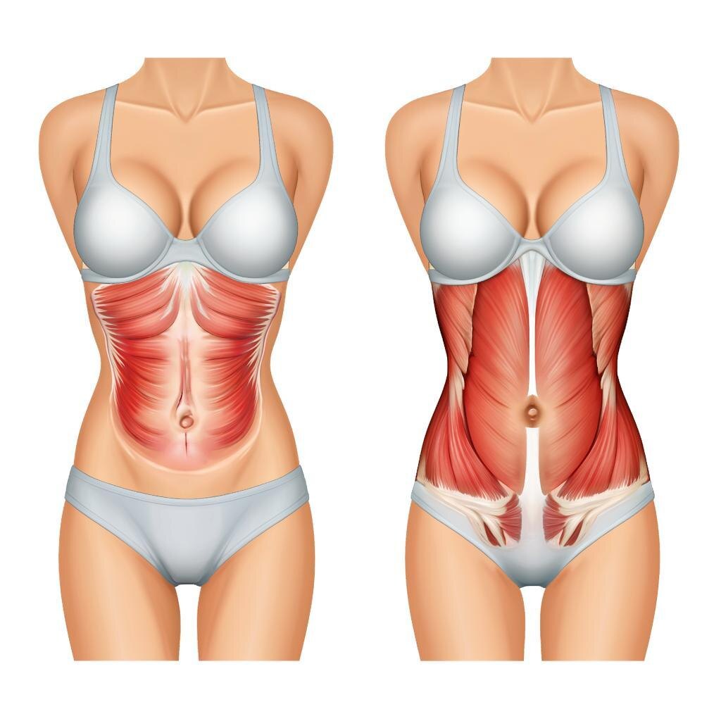 Слева мышцы разошлись. Справа нормальное расположение мышц. 