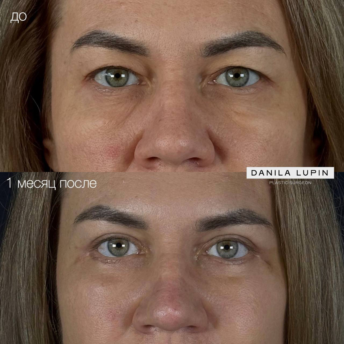 Результат круговой блефаропластики