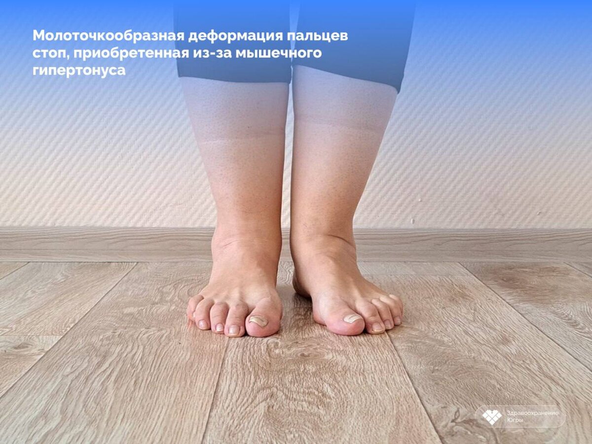    Сургутянке диагностировали крайне редкое заболевание