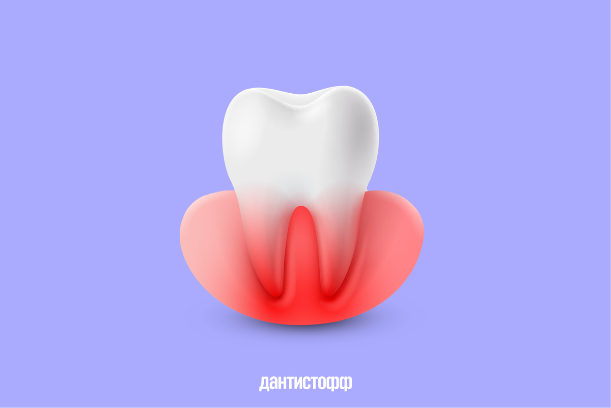 Не стоит полагаться на внешний вид зуба, ведь он никак не отражает глубину кариеса