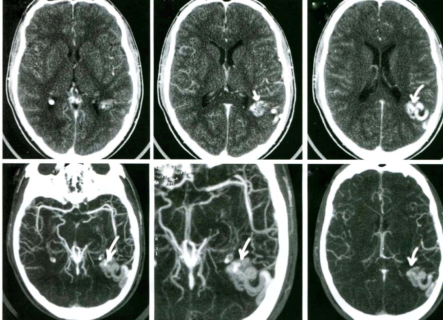 Так на МСКТ-ангиографии (МIP-реконструкция) выглядит артериовенозная мальформация (АVM) теменной области слева (указано стрелками) в виде клубка сосудов, интенсивно накапливающего контрастное вещество (кровоснабжение из конечных ветвей СМА)