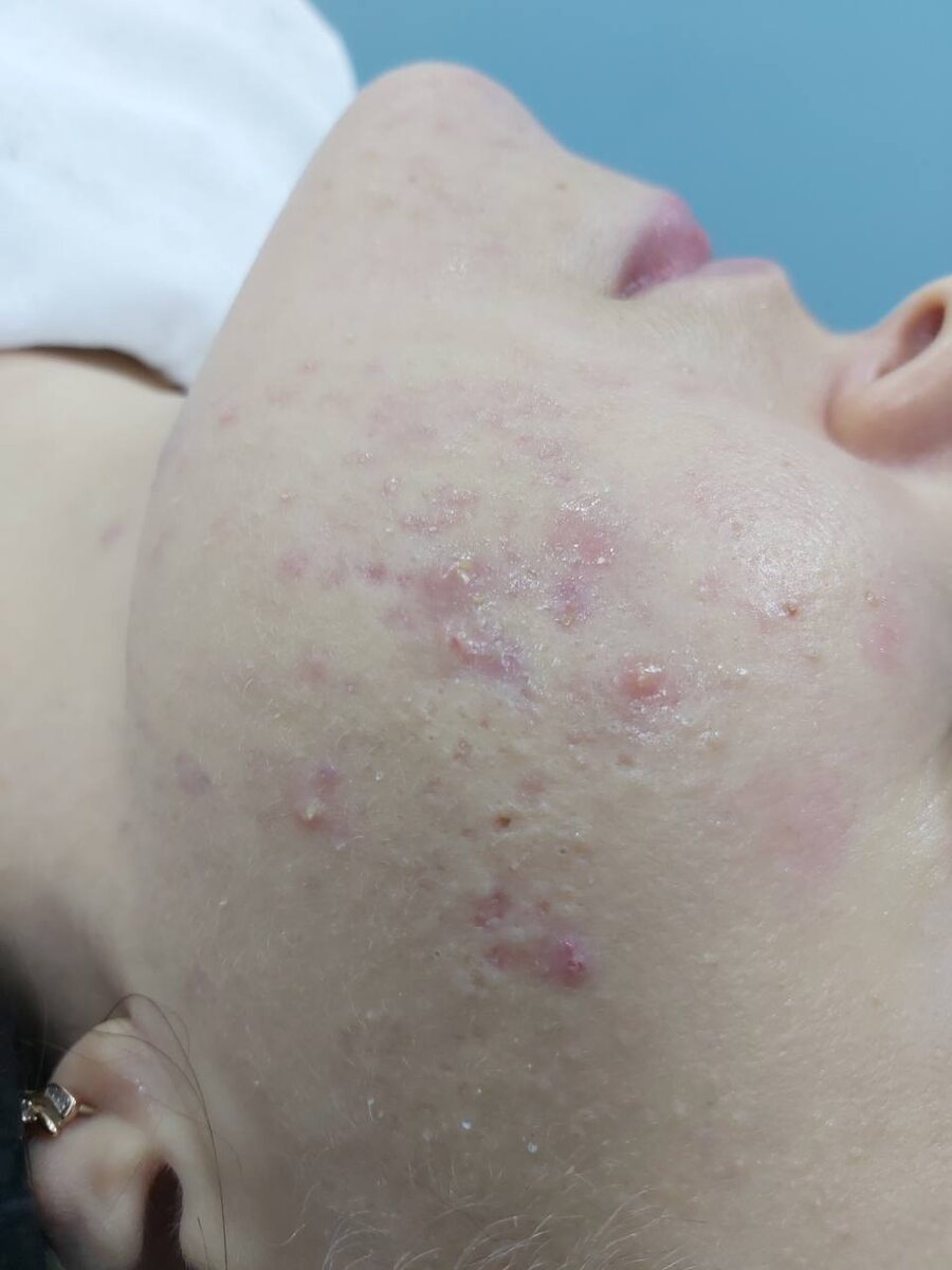С таким воспалением пациент пришел в Dr. Cosm, рецидив высыпаний вызвала поездка на море
