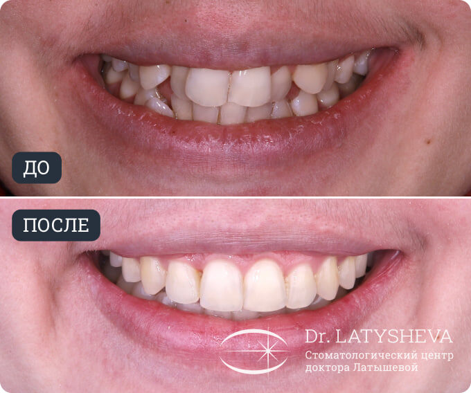 Лечение на брекет-системе Damon Q2