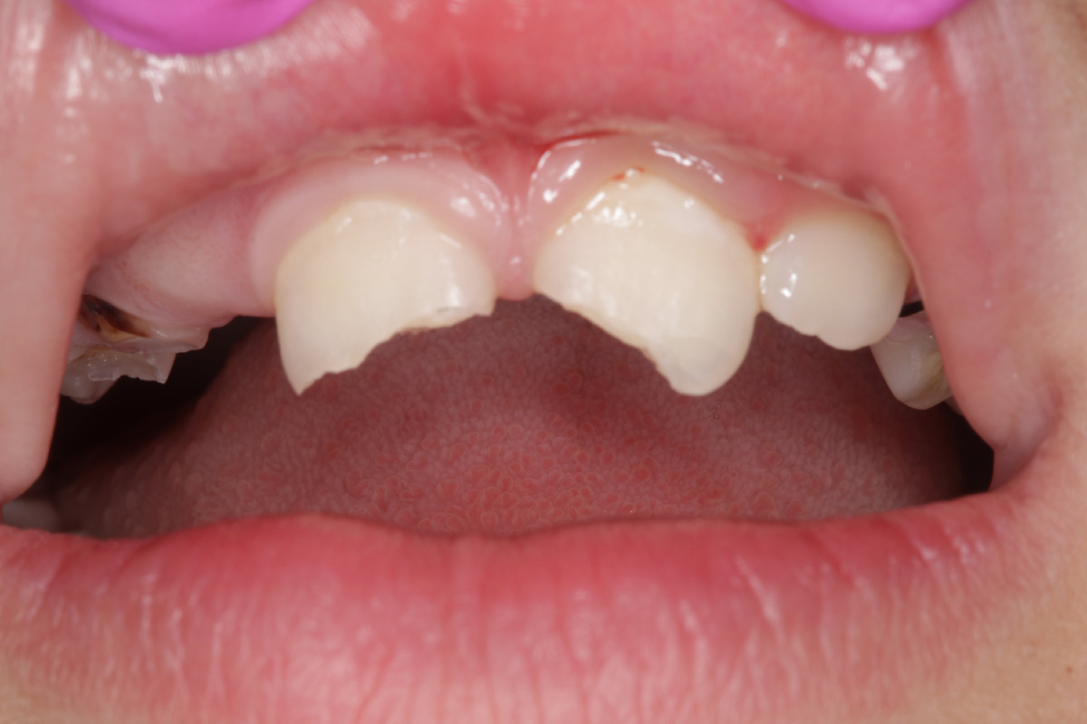 Пациент AB Clinic с переломом 2 постоянных резцов