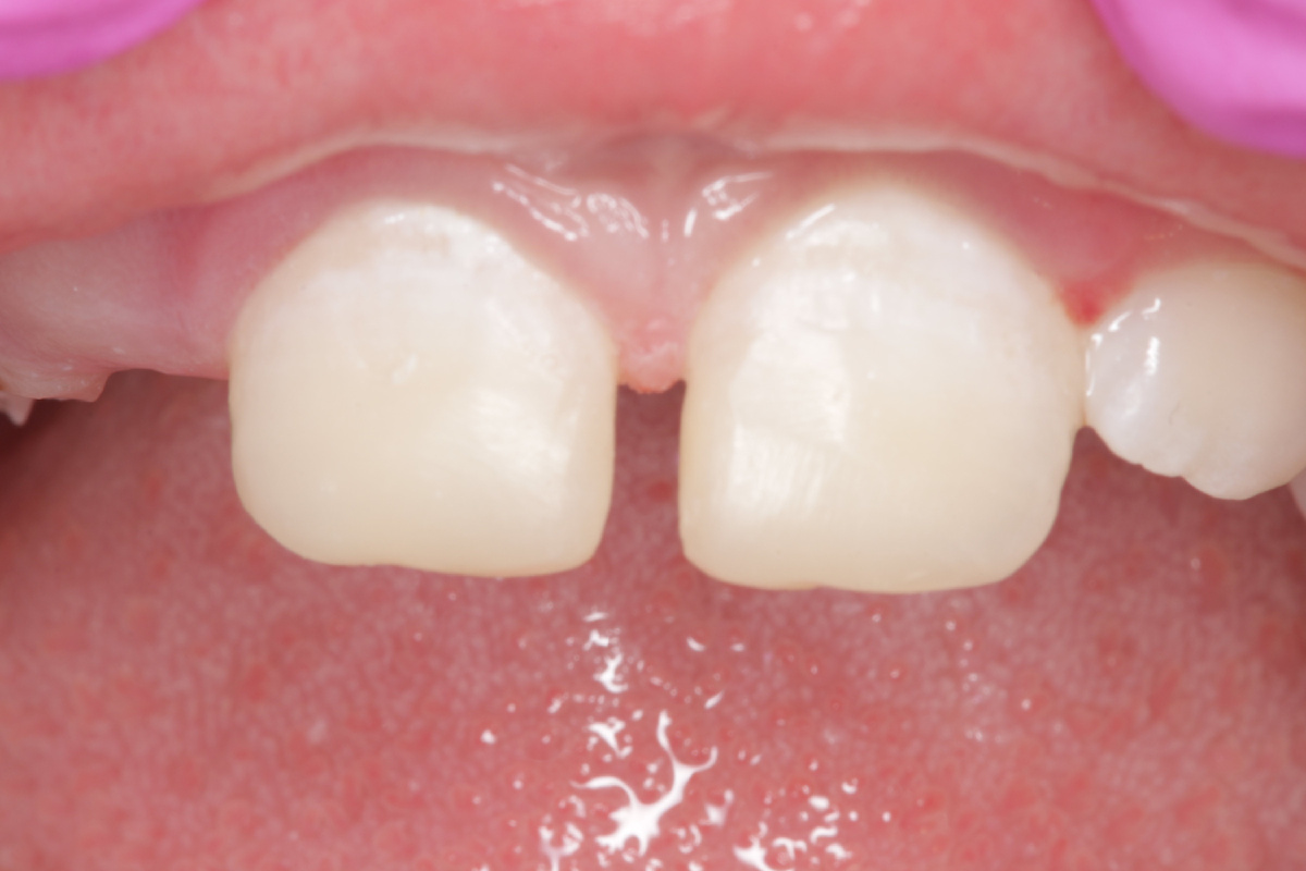 Результат: терапевт AB Clinic Мигранова Э.И. восстановила зубы аккуратной композитной реставрацией 