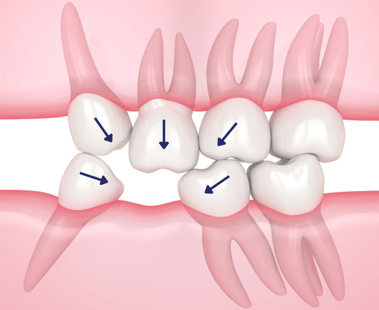 Смещение прикуса