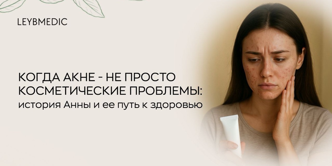 Когда акне - не просто косметические проблемы: история Анны и ее путь к здоровью