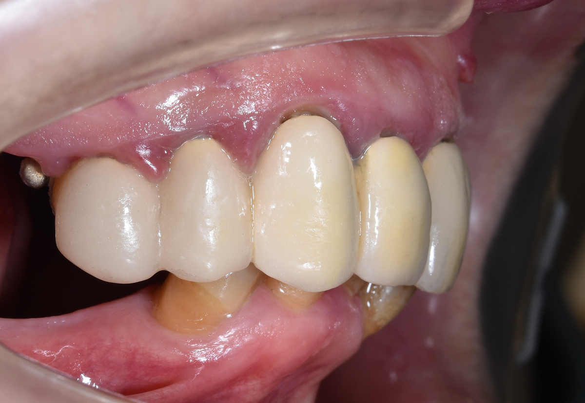 Металлокерамические коронки, отёк и гиперемия десны