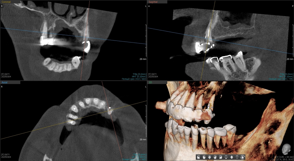 КЛКТ до лечения