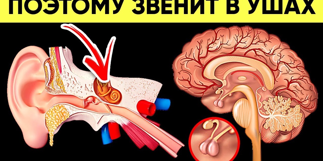 Почему шум в ушах может быть первым признаком инсульта!