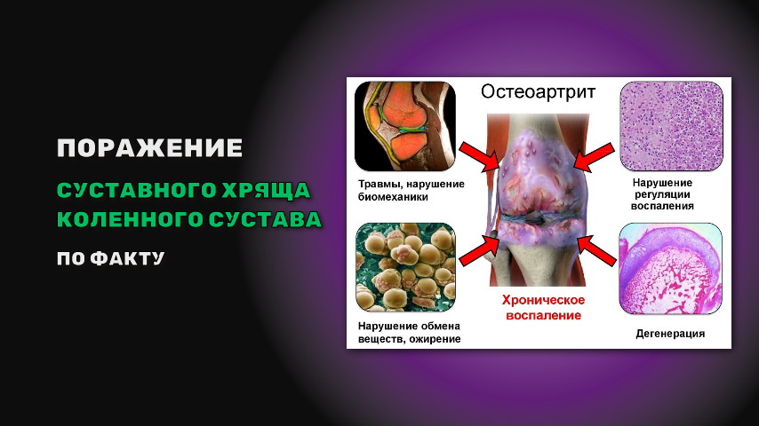 Боль в колене усиливается во время движения. Что это такое?