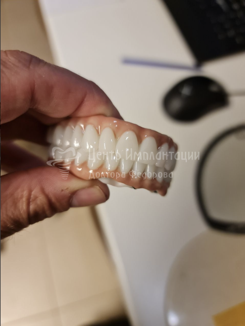 Адаптационные протезы были готовы в тот же день в собственной зуботехнической лаборатории клиники. 