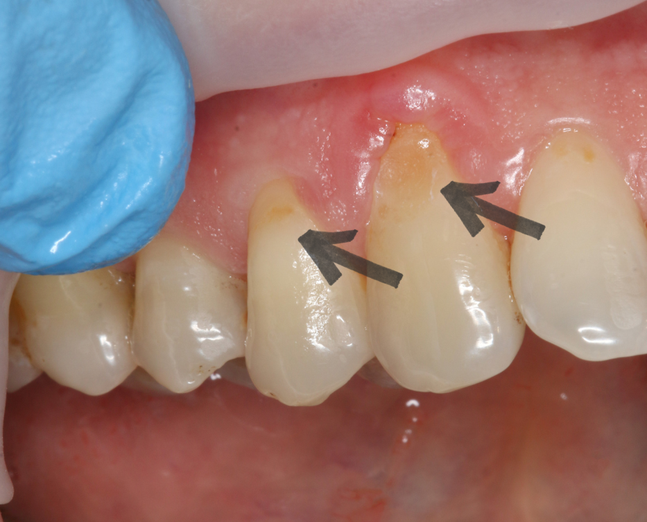 Пример клиновидных зубов 