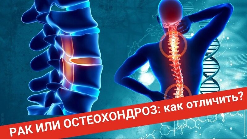 Боль в спине — рак или остеохондроз? Разница, которая спасает жизнь!