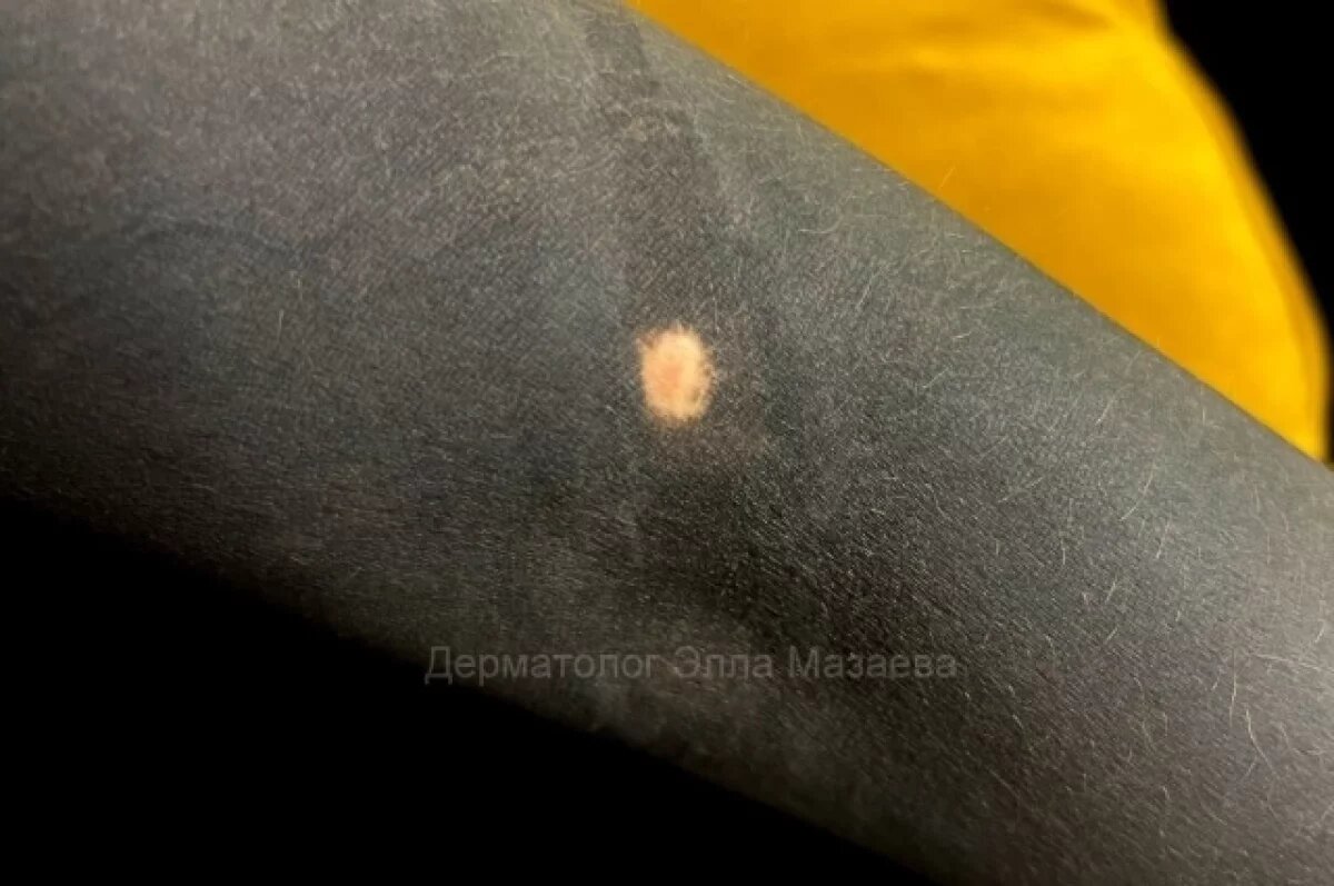    В Нижнем Новгороде родинка помешала набить татуировку