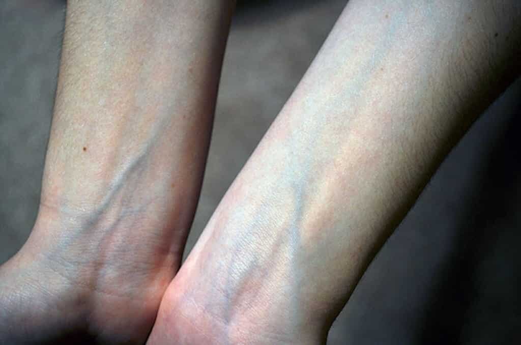    Вены не являются синими сами по себе, их цвет — это иллюзия, связанная с тем, как свет взаимодействует с кожей и тканями. Источник изображения: aminoapps.com