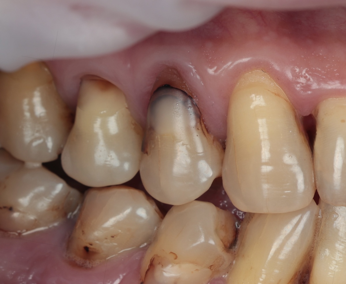 Несостоятельная пломба на зубе 1.4, а под ней кариес