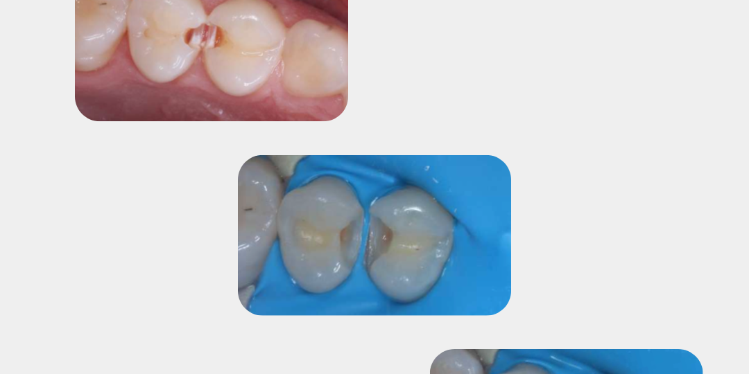 Как лечить контактный кариес?