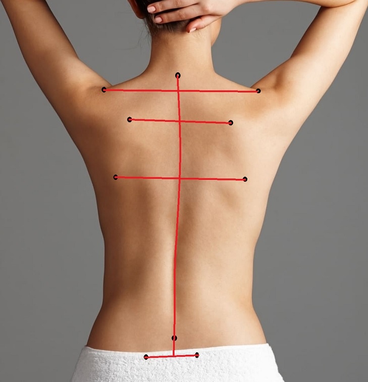 Пример использования анатомических ориентиров как для первичной оценки состояния позвоночника, так и для оценки эффективности лечения.