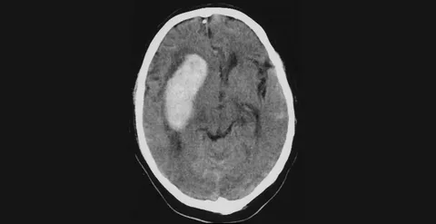При каком артериальном давлении чаще происходит инсульт?