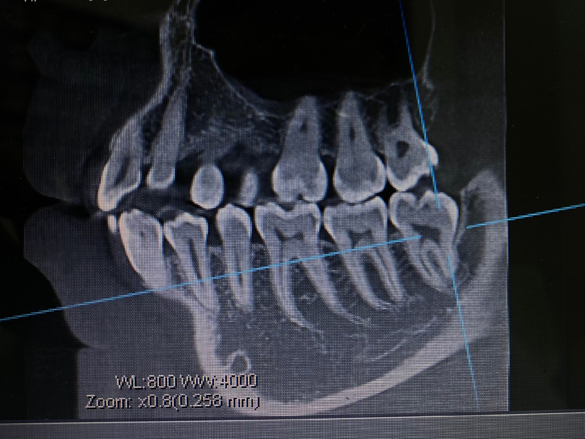 Снимок КТ перед удалением «восьмерки»