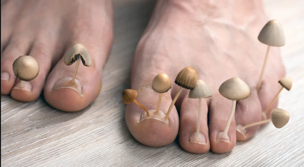 Как понять, что у вас грибок стопы и что с этим делать? Советы подолога