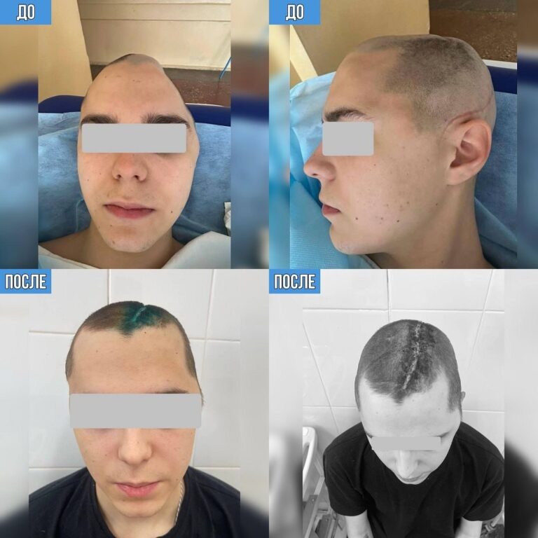    В Оренбурге хирурги восстановили череп 19-летнему пострадавшему в ДТП Оренбуржье